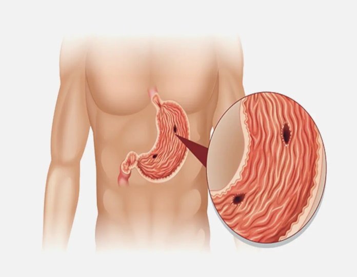 Peptic Ulcer