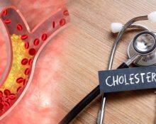 High-Cholesterol-Symptoms