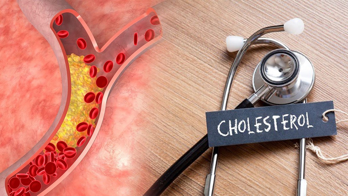 High-Cholesterol-Symptoms